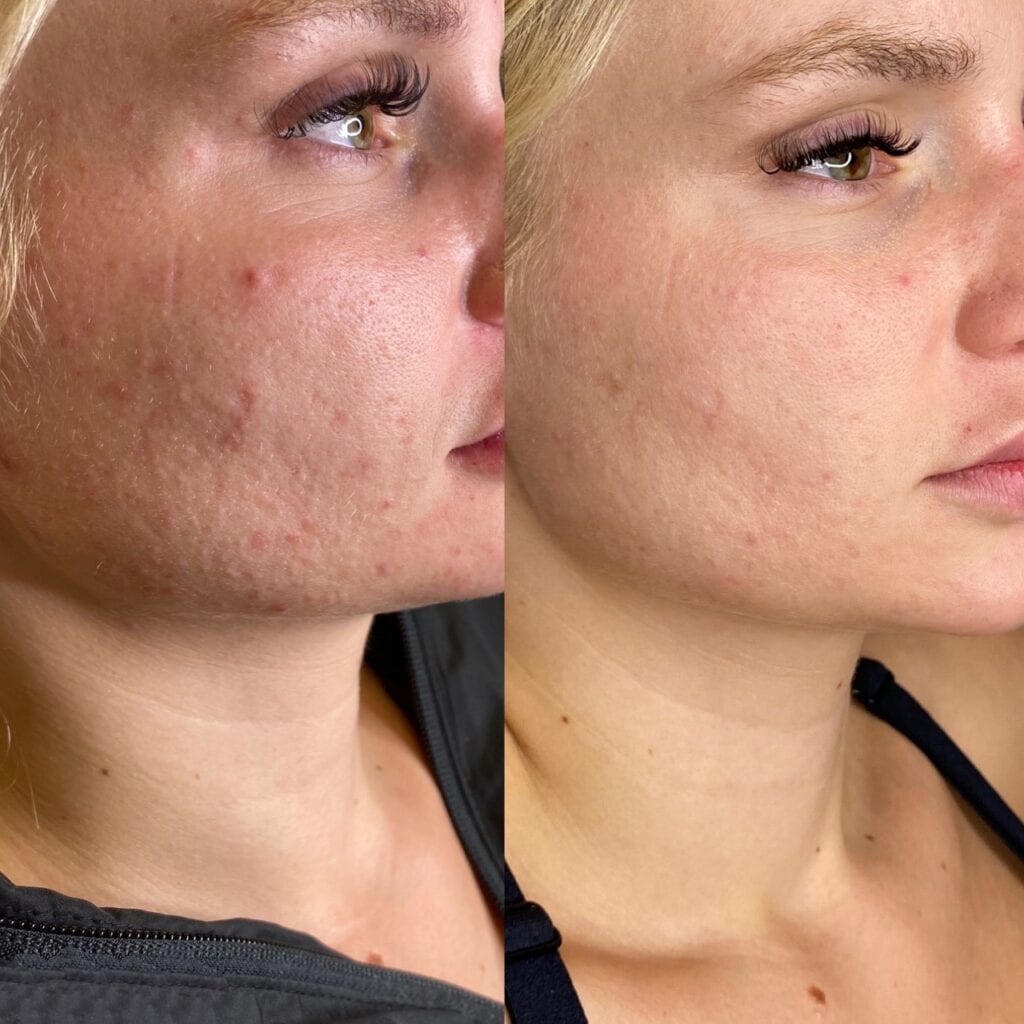 Before & After Facial - Buckhead, Atlanta