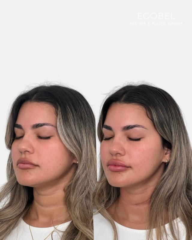Neck Tox and Lip Filler; 

We focus on balance and proportion—adding subtle volume, smoothing lines, and enhancing your natural shape. Neurotoxins can be used in so many different areas than just the face.

Neck Botox helps relax vertical bands, soften fine lines, and subtly lift the jawline for a more refined, youthful profile. A small treatment with a big impact on confidence.

✨ Now booking—click the link in bio to schedule.

#NeckBotox #BotoxAtlanta #TechNeckTreatment #SmoothJawline #BuckheadMedSpa #SubtleRefinement #EcobelAesthetics #SkincareWithPrecision