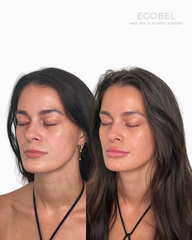 Subtle. Balanced. Undeniably you.⁠
⁠
Our approach to lip filler is never overdone — just structure, shape, and soft volume where it counts. Think hydrated, plush lips that still feel like yours.⁠
⁠
Book your lip treatment with Ecobel!⁠
⁠
⁠
⁠
⁠
⁠
⁠
⁠
⁠
⁠
⁠
⁠
⁠
⁠
#LipFillerAtlanta #NaturalLipFiller #BeforeAndAfterLips #AtlantaInjector #LipGoals #LipsATL #MedSpaBuckhead #BuckheadMedSpa #NaturalEnhancement #AtlantaSkinClinic #TransformationTuesday