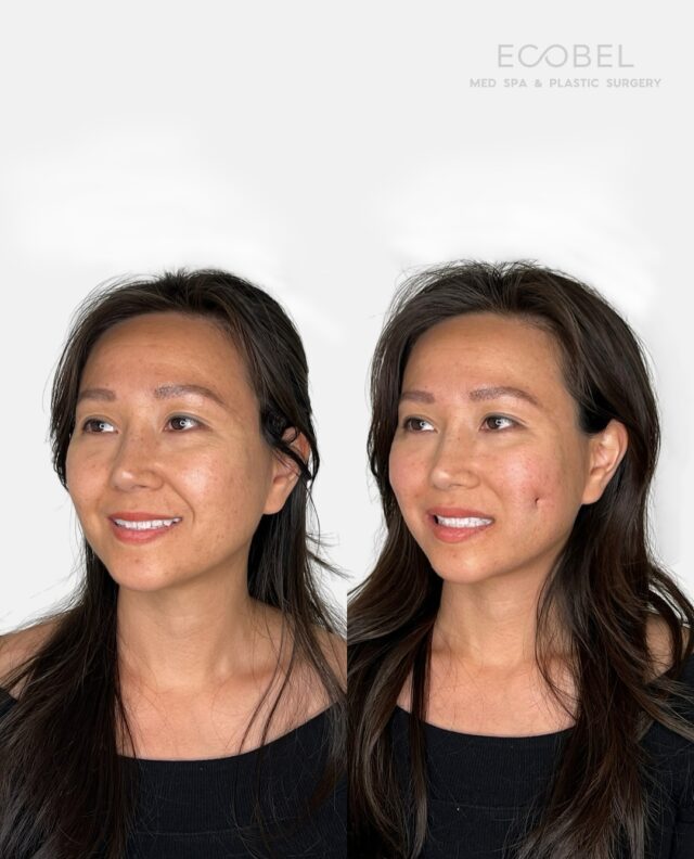 Dimpleplasty; 

Dimpleplasty is a minimally invasive procedure that enhances your smile with beautifully subtle, yet noticeable results.

Dimples will appear more pronounced during the first 2–4 months as the area heals. Once sutures dissolve, the dimples will soften and appear more natural, especially when smiling.

Performed by Dr. Movagharnia, a double board-certified surgeon with extensive experience in both facial and body aesthetics. At Ecobel Med Spa, we specialize in delivering natural, customized results tailored to your unique beauty goals.

Schedule your consultation today!

#AtlantaPlasticSurgery #Dimpleplasty #DimpleplastyAtlanta #AtlantaDimpleplasty 
#Dimples #DimpleGoals #Beauty #CosmeticSurgery #PlasticSurgery #BoardCertifiedSurgeon #NaturalResults #AtlantaMedSpa #BuckheadAtlanta #EcobelMedSpa