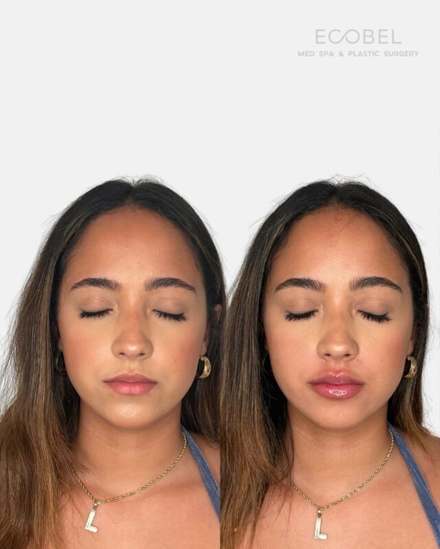 A summertime lip plump

Choosing a trusted provider and considering their professional recommendations is important. 

At Ecobel our injectors have years of experience with different fillers. We do not inject all of our patients with the same product. We create a customized treatment plant that pairs with your aesthetic goals.

Send us a DM to get a free consultation

#lipfillerstlanta #lipsatlanta #atlantamedspa