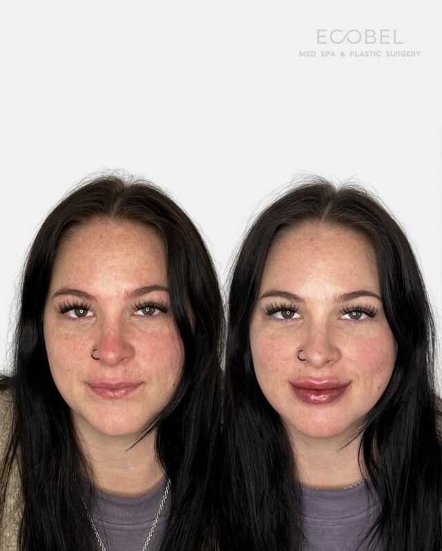 Lip Filler Treatment; 

Lips, refined but still you.

We use hyaluronic acid filler to restore volume, enhance shape, and smooth fine lines without overfilling.

The goal is to be balanced, natural-looking lips that feel like you, just a little better. Book your lip consultation through the link in bio. 

#LipFillerATL #NaturalLipResults #EcobelMedSpa #BuckheadInjector #AtlantaAesthetics #LipGoals #lipfilleratlanta #atlantalipfiller #atllipfiller
