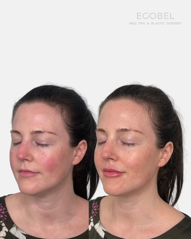 Natural Lip Enhancement….

Tailored to your face. Lips are not a one size fits all. All our patients receive a thorough consultation to discuss any of your needs before we do treatments. The Ecobel Way is to ensure you leave the door with exactly what you wanted. Send us a DM or use the link in our bio to book.

#medspa #atlantamedspa #atlantabotox #atlantalipfiller #naturallip #naturallipfiller #atlantaspa