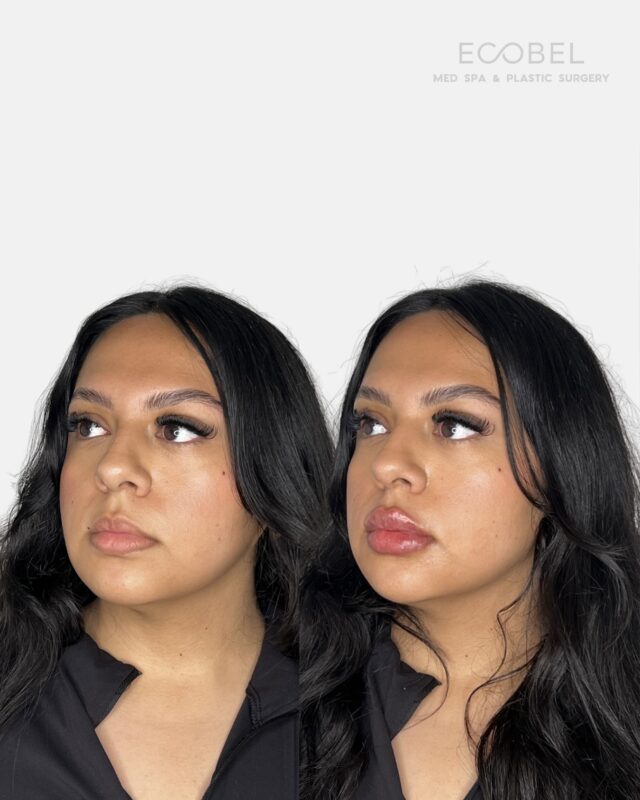 Seamless shape. Confident results.

Our lip filler treatments are designed to enhance your beauty. Our injectors specialize in customizing each treatment to your natural shape. Personalized to your features.

Click the link in bio to book your appointment or DM us for a FREE consultation💌

#lipfillers #lipfillerbeforeandafter #atlanta #atlanalipfiller #atlantamedspa #atlantaspa