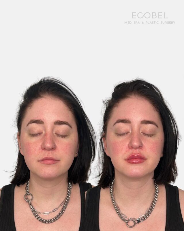 At Ecobel, we take a subtle, shape-first approach to lip filler. That means restoring volume where it’s naturally lost, refining symmetry, and enhancing your features.

Soft. Balanced. Undetectably done. Click the link in bio to book your appointment! 

#AtlantaMedSpa #buckheadbotox #atlantaaesthetics #atlinjectables #atlantaskincare #atlantamedspa #atlantabotox #atlantaspa #atlantainjectables #atlantaplasticsurgery #atlantaplasticsurgeon