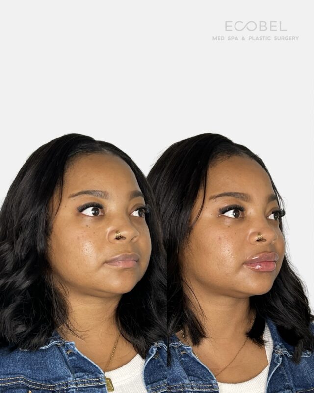 A lovely transformation with lip filler…

One syringe of lip filler can go a long way. If you are wanting to get lip filler but don’t know if it is right for you book a consultation. We also offer half syringes if you are wanting to start small. Each treatment plan is tailored to you! 

Send us a DM or call to book your appointment (404) 960 0812

#lipfilleratlanta #atlantalipfiller #atlantamedspa #atlanta #buckheadbotox #atlantabotox #atlantainjector #atlantainjectables #buckheadinjector