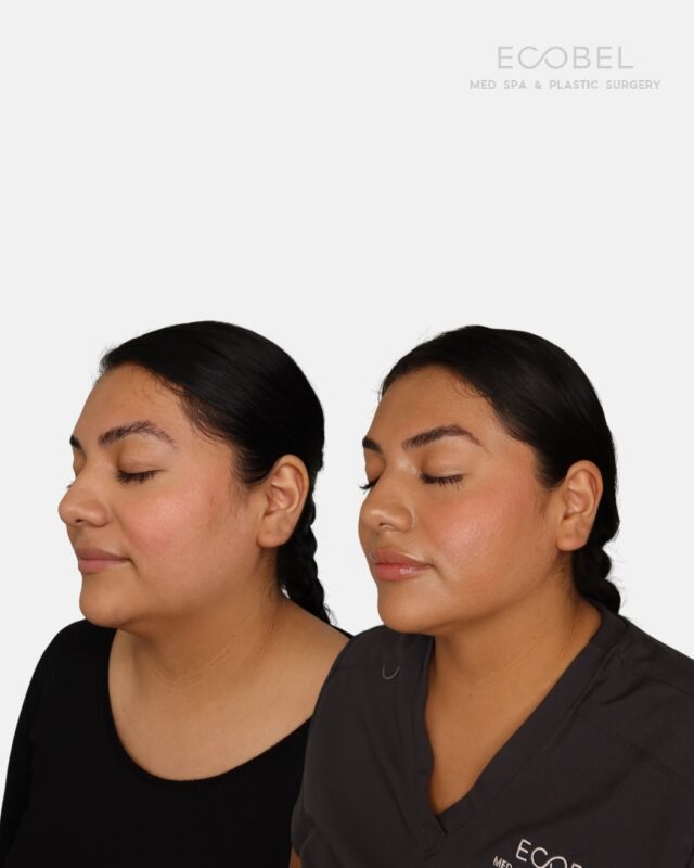 Subtle sculpting, striking results

Our Buccal Fat Removal + Chin Liposuction treatment works to refine your natural contours giving you a more defined jawline and cheekbones without looking overdone.

This combo treatment targets excess fullness in the lower face and under the chin, creating a slimmer, sculpted more balanced profile.

Book a consultation to see if you’re a candidate.
Atlanta, GA | Ecobel Med Spa

#FacialContouring #BeforeAndAfter #AtlantaMedSpa #FacialSculpting #BuccalFatRemoval #ChinLipo #NaturalResults #ConfidenceInYourSkin #MedSpaATL #atlantaplasticsurgery #atlantaplasticsurgeon #atlantaplasticsurgeons