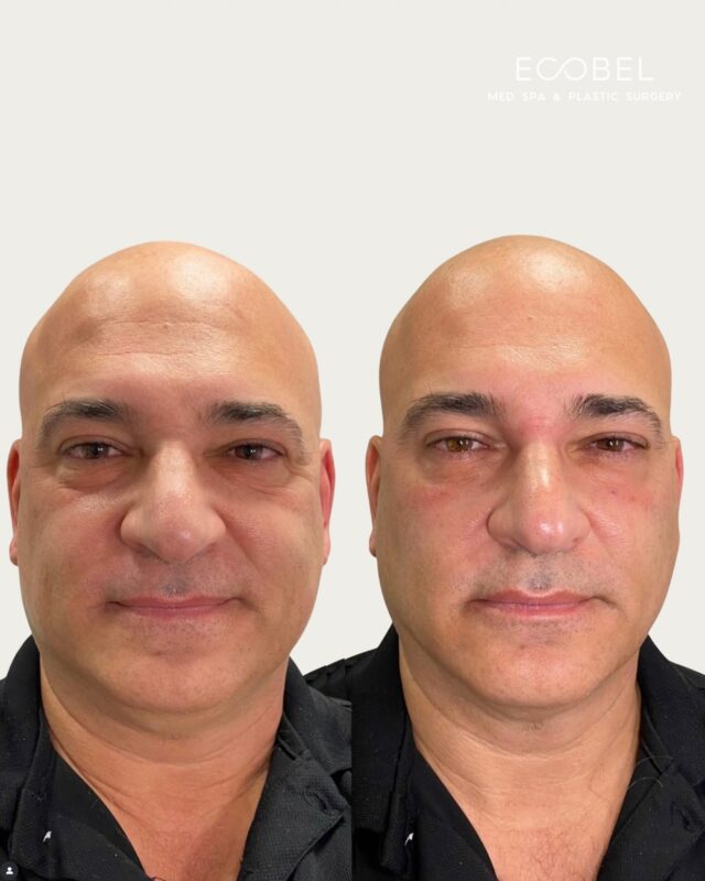 Undereye Filler;

Immediate results with under eye filler. At Ecobel we have several options for under eye filler treatment. We can treat with hypotonic acid filler, PRP and PRF EZ Gel. 

Tear trough treatments have clients looking completely refreshed and rejuvenated. If you continuously look tired due to any eye bags or hollowing under the eyes, THIS treatment is for you!

#atlantaundereyefiller #atlmedspa #at|botox #atlantabotox
#atlantamedspa #atlmalemodels #atlbeauty #atlantabeauty #atlantablogger #atlantabusiness #atlbusiness #undereyefiller #undereye