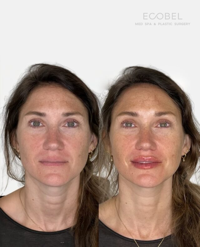 Lip Filler the Ecobel Way;

Enhancing your natural beauty and shape. Lips are a big part of facial balance. We focus on facial balance and natural-looking aesthetic work. 

The ‘Ecobel Way’ is always making you look like yourself but better. We focus on enhancing your natural beauty and creating harmony within your facial features.

#lipfillertreatment #juvedermlips #restylanelips #atllipfiller #atlinjector #atlantalipfiller #dermalfillers #exploreatlanta #buchkeadmedspa #atlantamedspa #lipsbeforeandafter #liptransformation #lipfillertreatment #juvedermlips #restylanelips #atllipfiller #atlinjector #atlantalipfiller#dermalfillers #exploreatlanta