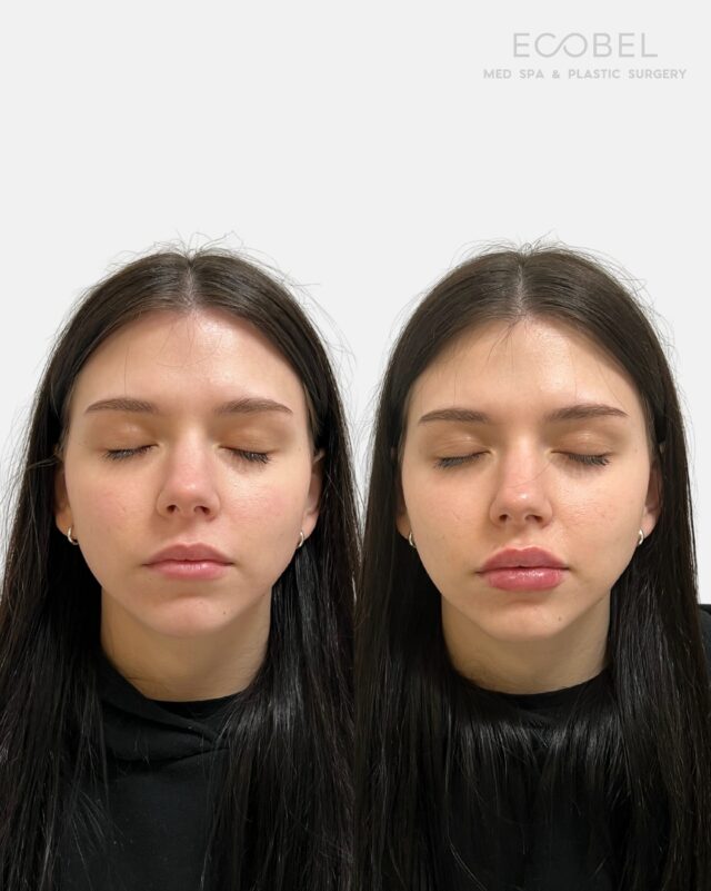 Natural and Plumped. Lips are not a one-size-fits-all. 

At Ecobel, every filler treatment starts with a consultation so we can customize volume and shape to your goals.

Book using the link in our bio. 

#atlantalipfiller #atllipfiller #buckheadlipfillers #atlantainjector #atlantainjectables #atlinjector #buckheadmua #buckheadmedspa #buckheadlipfillers #buckheadspa #buckheadmedspa #atlantamua