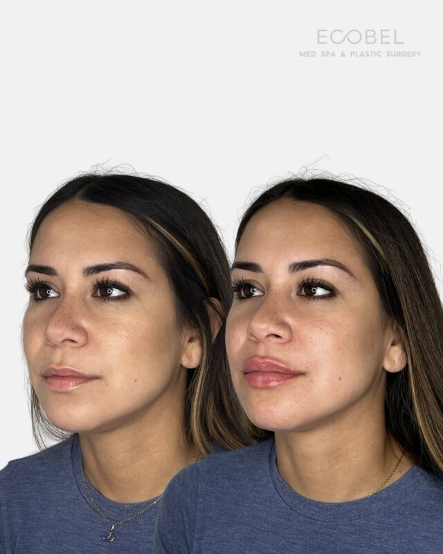 Soft, balanced, never overdone. 

Lip filler is about enhancing what you already love, adding volume, smoothing lines, and creating a natural finish that feels like you, only more polished.

Adding hydration, harmony, and just the right touch.

Book now using the link in our bio.

#atlantabotox #atlantalipfiller #atlantalip #atlantainjector #atlantainjectables #atlantadesigner #atlanta #buckheadbotox #buckheadlipfillers