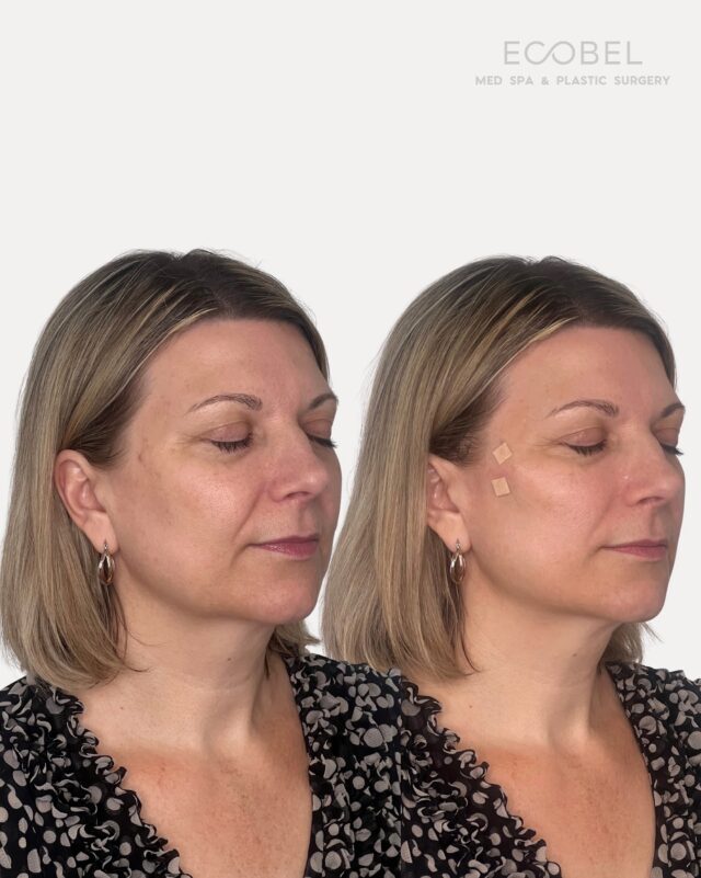 PDO Threads;

Lift and Tighten Without Filler. PDO Threads offer a subtle, sculpted lift by targeting areas like the cheeks and smile lines, helping smooth wrinkles and restore definition without adding volume.

The best part about this treatment is the threads stimulate your body’s own collagen production, so your results continue to improve over time. Naturally enhancing firmness and elasticity for a youthful, long-lasting lift.

Book your consultation today! 

#atlantamedspa #atlantabotox #buckheadbotox #atlantafacial #atlantafacelift #atlantamedical