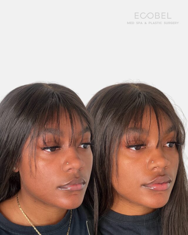 A little volume goes a long way.

Lip filler doesn’t have to mean “big change”sometimes it’s just about restoring balance, softening lines, and adding that subtle plump that makes your smile feel refreshed.

Every lip is different, which is why our providers always customize your treatment during a one-on-one consultation. 

DM us to schedule your lip consultation or use the link in our bio to book. 

#LipFillerAtlanta #EcobelMedSpa #AtlantaMedSpa #LipEnhancement #DermalFillers #NaturalResults #PlumpLips #FillerExperts #atlantalipfiller #atlantabotox
