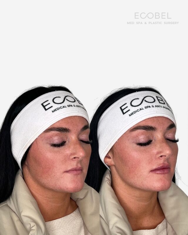 At Ecobel, lip filler is never one-size-fits-all. 

We customize every treatment to enhance your unique lip shape, whether you’re looking for a subtle enhancement, a soft lift, or fuller volume.

Our providers work with a variety of filler options so we can create results that look natural and complement your features. From enhancing definition to balancing proportions, your treatment plan is tailored just for you.

#lipfiller #atlantamedspa #atlantabotox #atlanta #atlantaspa #atlantatox #buckheadbotox #atlantaplasticsurgery #atlantasurgery #atlantaplasticsurgeon