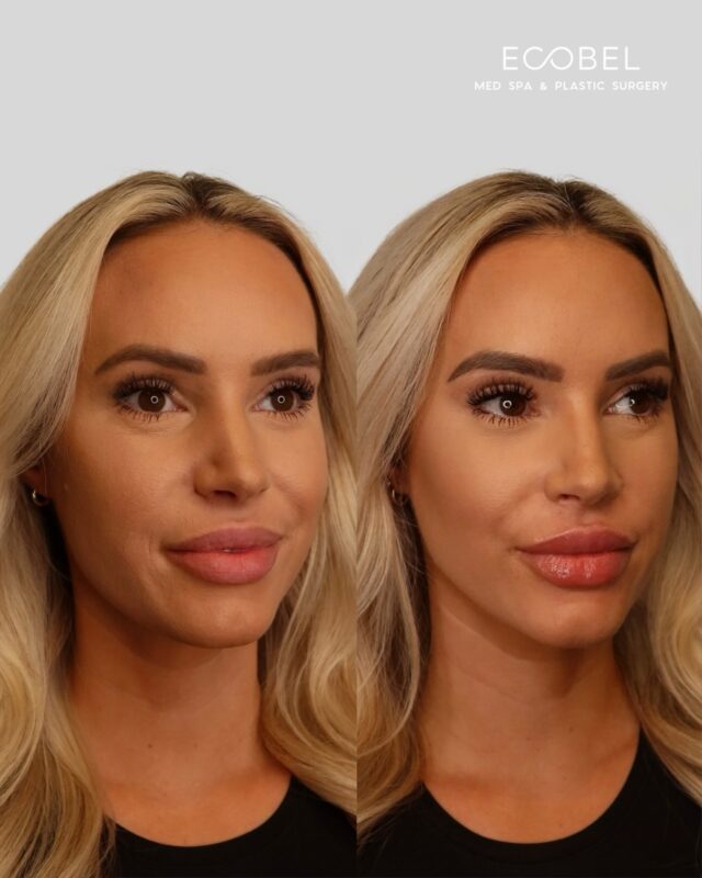 A little filler goes a long way!

Our beautiful client got half of a syringe to help fill her lips. We were able to keep her natural shape and half a syringe was the perfect amount.

Lip filler does not have to look over done. We have several different types of fillers and can use half or a full syringe to help you achieve your lip goals.
Book your appointment today!

#atlanta #atlantalipfiller #buckheadlipfillers #atlantainjector #atlantainfluencer #atlantabotox #buckheadbotox #atlantamedspa #atlantaspa #atlantamua #juvederm® #juvedermlips