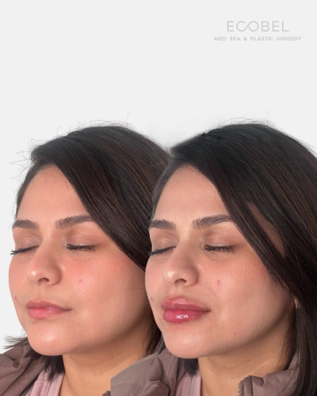 Say Hello to our October Lip Special.

Natural, plump, and customized to your lip goals. This month get lip filler for only $599 (normally $750) Schedule your appointment now! 

#atlantabotox #atlantalipfiller #atllipfiller #atlantamedspa #atlmedspa #atlchinfiller #atlantamicroneedling #atlanta