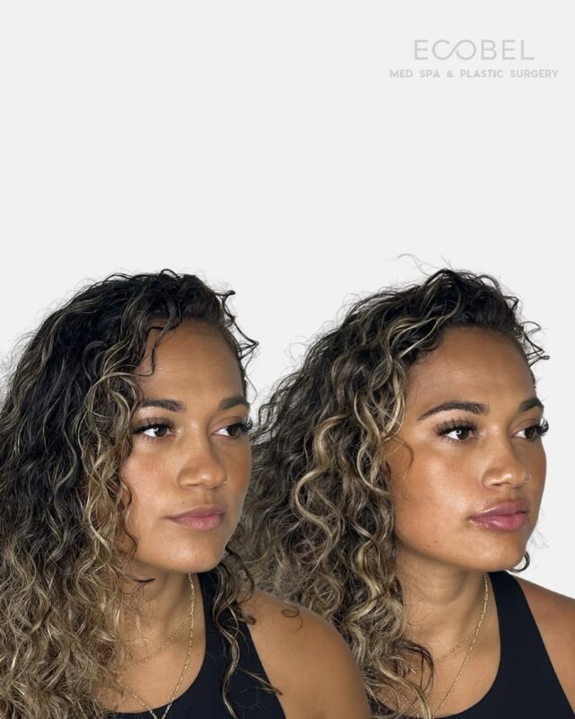 A subtle lip filler transformation for our beautiful client.

Each lip treatment is completely customized, from filler type and technique to shape, ensuring results that complement your natural features.

#lipfillers #restylanekysse #atlantabotox #atlanta #atlantafillers #atlantalipfiller #atlantabeauty #atlantainfluencer #buckhead #buckheadbotox #buckheadatlanta