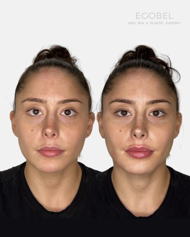 Natural Lip Filler Enhancement.

We love a natural lip filler focused on shape and definition with @restylane 

The Ecobel way is about enhancing.

Our approach to lip filler and facial treatments focuses on balance, proportion, and the subtle details that make your features uniquely beautiful, naturally.

#lipfillerbeforeandafter #restylanekysse💋 #lipfilleratl #atlantalipfiller #atlantamedspa #atlantaspa #atlantaplasticsurgery #atlanta #buckheadatlanta #buckheadspa #buckheadbotox