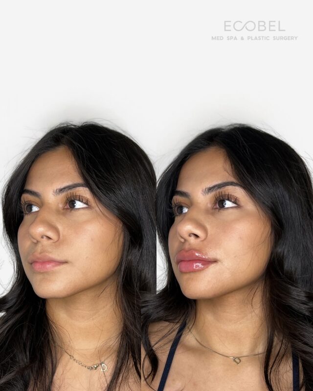 Now’s the time for holiday prep!
We recommend scheduling treatments at least 4 weeks before any big event and our Lip Filler Special is still live for $150+ off only $599 for a full syringe normally $750! 
DM us or call (404) 960-0812 to book your appointment.
#lipfillers #atlantalipfiller #atlantalipfillers #atlanta #buckhead #buckheadmua #buckheadplasticsurgery