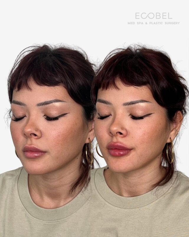 The perfect pout in time for the holidays! 

Add volume, definition, and hydration with our lip filler. Book your consultation today.

#lipfillerbeforeandafter #lipfiller #atlanta #atlantalipfiller #atlantabotox #atlantamedspa #atlantafacial #atlantafacialplasticsurgery #atlantarhinoplasty #atlantaspa