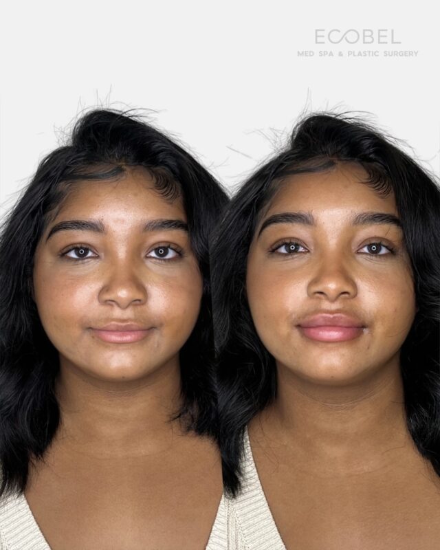 A beautiful natural before and after.

Our philosophy is simple: natural results, elevated confidence. Every treatment is designed to enhance your features while keeping everything soft, balanced, and authentically you.

#lipfilleratl #atlantabotox #atlantamedspa