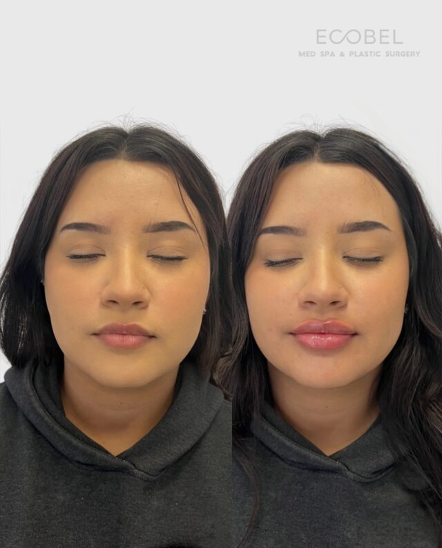 A perfect plump 

Shape, volume and symmetry. Our approach to lip enhancement is personalized and precise.

#lipfilleratlanta #lipfillerbeforeandafter #buckheadmedspa #buckheadfiller