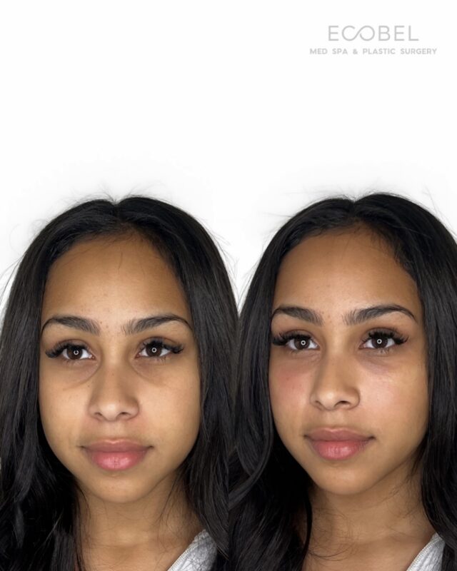 PRP Gel;

This is one of our favorite treatments. The gel is a natural way to restore volume and rejuvenate the skin with your body’s own regenerative growth factors.

A low risk treatment using all- natural injectable that improves discoloration and boosts collagen production in the area. 

A great treatment for under eyes and laugh lines. Book your treatment today. 

#atlantaundereyefiller #atlantainjector #medspa #undereyefiller #prpgel #undereyeprp #injectables #buckheadmedspa