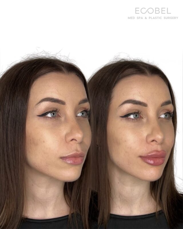 Enhancing what’s already yours with definition. 

Every lip treatment is customized to your natural anatomy. We focus on balance and symmetry.

#atlantainjector #atlantainjectables