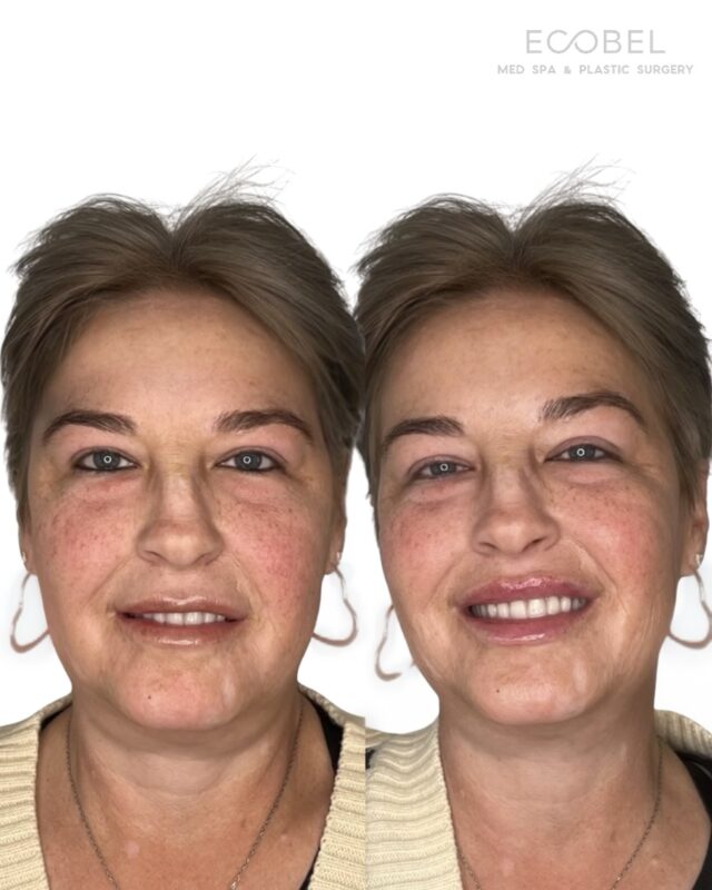 Our favorite transformations are subtle enhancements. Lip filler that looks natural, balanced, and effortless. We offer three different types of lip filler so every result is tailored to you.

#atlantipfillers #atlatabotox #atlantaplasticsurgery