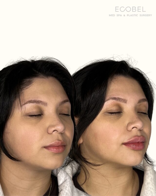 The perfect combination of lips and bows. Subtle enhancements the Ecobel Way to showcase our clients features.

Call to book your appointment today (404) 960 0812

#atlantalipfiller #atlantabrow #atlantabrows #atlantabrowlamination