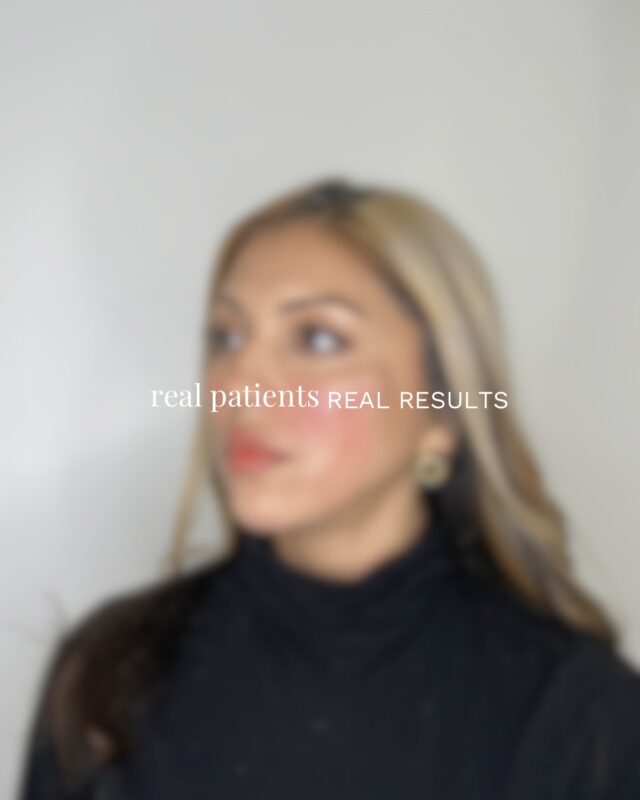 Real patients. Real results.

Because personalized treatment plans make all the difference. Book a consultation to start your journey.

We treat every face differently. Each dermal filler plan is customized with intention, precision, and respect for natural beauty. The Ecobel way.

#atlantamedspa