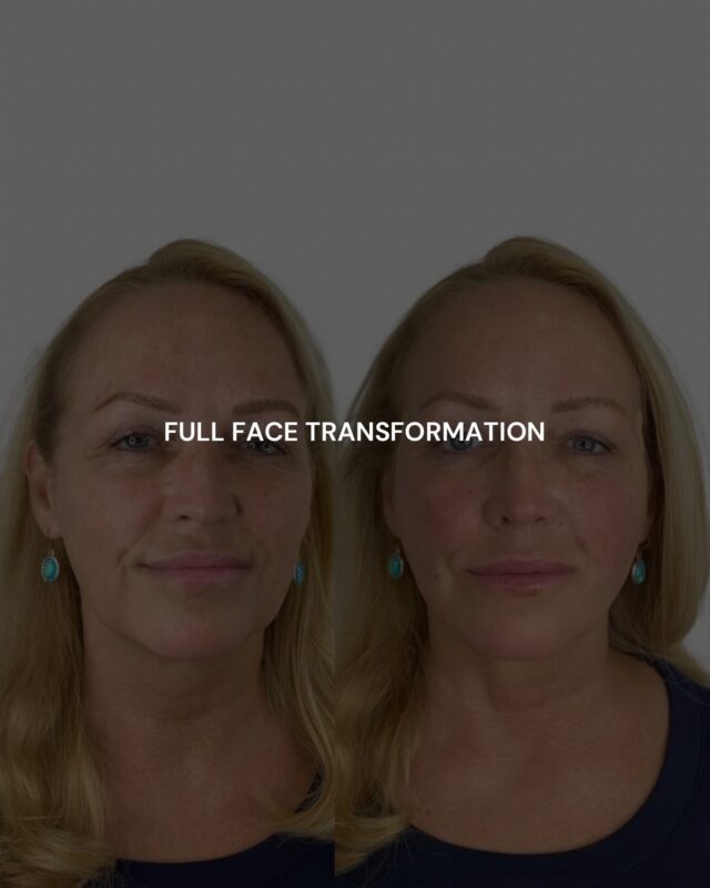 Full face transformation, the ‘Ecobel Way’

This beautiful patient got threads paired with lip filler to restore balance and soften the lips. 

Threads can create a subtle “facelift” effect with less downtime. They lift and contour to diminish your jowls and soften smile lines, all in one treatment.

Thoughtful, tailored, and a truly refreshed look.

#atlantafacelift #atlantaplasticsurgery #atlantaplasticsurgeon #atlantamedspa #buckheadmedspa