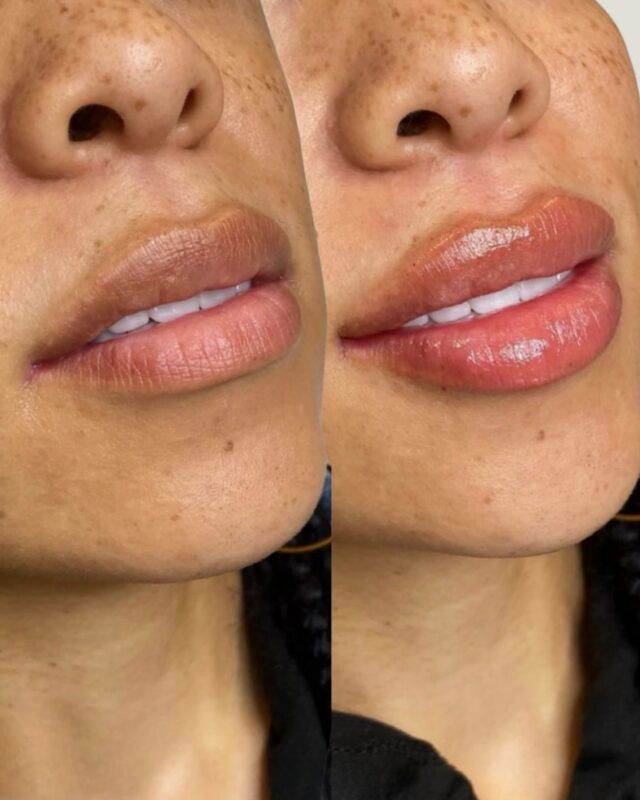 Our lip enhancement is designed to complement your natural shape.

This transformation is a look at the ‘Ecobel Way’ of a lip enhancement. A refreshed shape, restored volume, and natural definition.