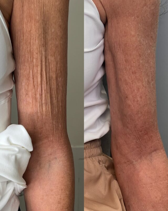 Real results with Endolaser. 

A minimally invasive treatment that helps tighten loose skin and stimulate collagen for smoother, firmer arms.

Endolaser can also be used throughout the face and body to improve skin laxity, refine contours, and support collagen production.

#endolaser #atlantaplasticsurgery #atlantainjectables