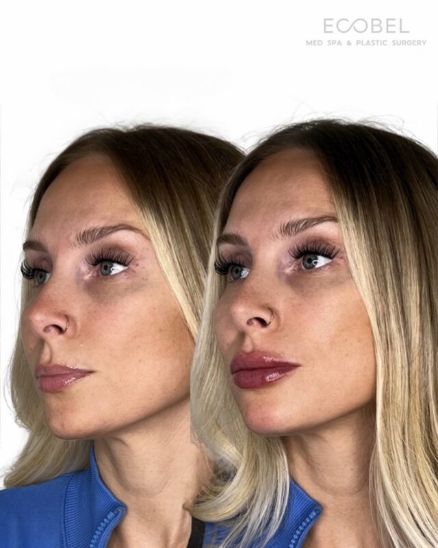 A lip enhancement, elevated. 

Subtle lip filler for a fuller, defined look that’s still your lip shape. We tailor each treatment towards your goals. Our approach is fully customized to your unique features, enhancing what’s already there for results that feel natural, refined, and effortlessly you. 

- - - - - 

Ecobel Med Spa & Plastic Surgery
Call (404) 960 0812 to Book
