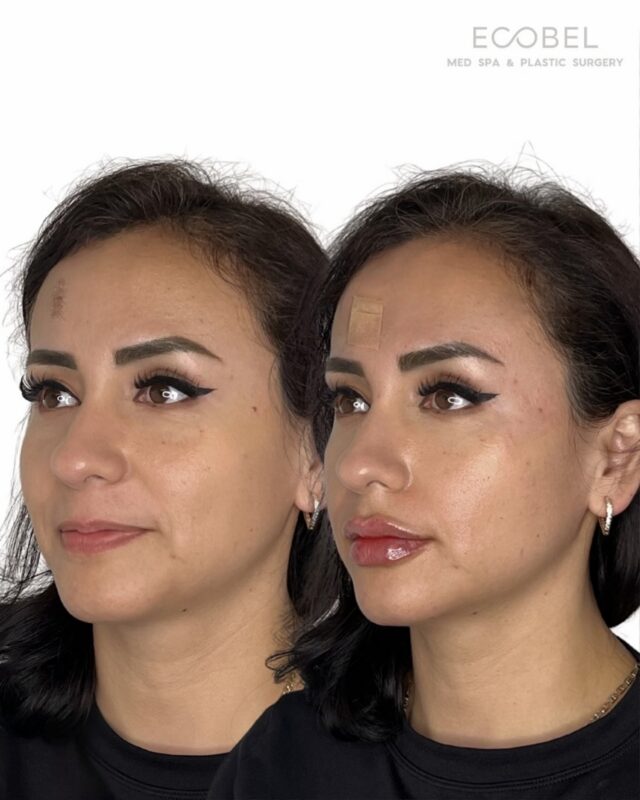 Lip Filler and Cosmetic Skin Treatment 

This lovely client came in for lip filler treatment along with a target skin procedure on the forehead. Every treatment plan is customized to enhance natural features while addressing individual concerns. 

Before and after shows immediate results, healing time is different for every patient. At Ecobel we target cosmetic, surgical and medical treatments.

#atlantaplasticsurgery #atlanta