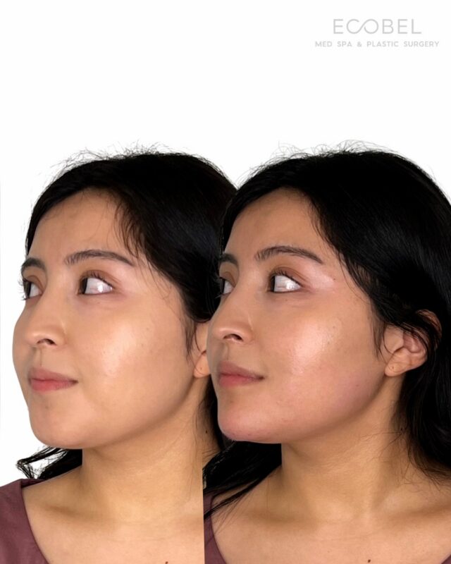 One of our favorite treatments. 

Chin filler doesn’t just add projection, it rebalances the whole face. A more defined jawline, softer neckline and a natural V shape lifts the face. No downline, just placement that works with your bone structure. 

Swipe to see the difference. Link in bio to book.