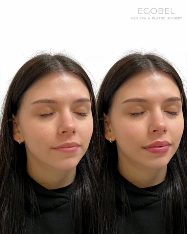 A natural, subtle lip filler transformation. 

We specialize in undetectable filler. During your consultation we learn your lip goals from there we customize each treatment plan to fit just the way you envisioned. 

Call us to schedule your appointment.