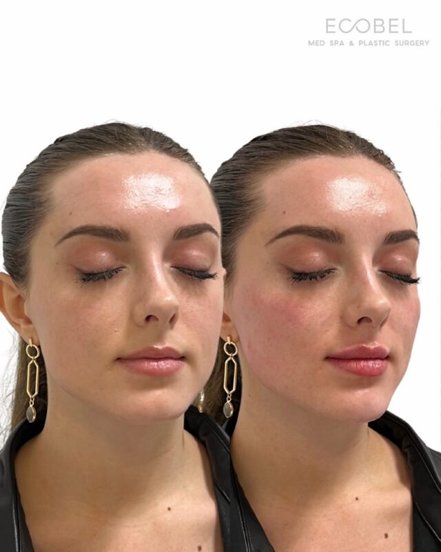 Harmony, not transformation. 

Proportion is everything with filler. Full face balancing with cheek and lip filler for a refined look, not redone.
