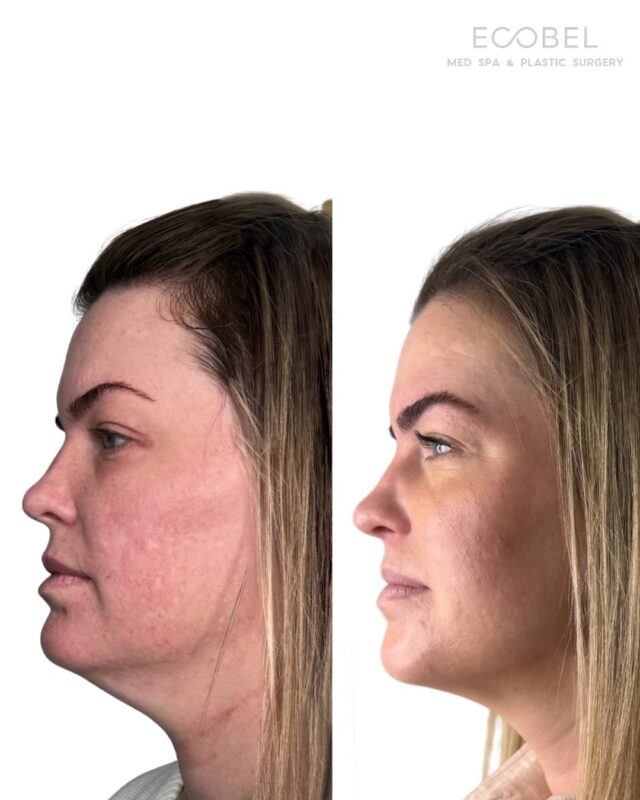 Lower facial harmony with Endolaser.

Laser energy delivered beneath the skin for tightening, contouring, stimulating collagen from within. No surgery, no downtime.