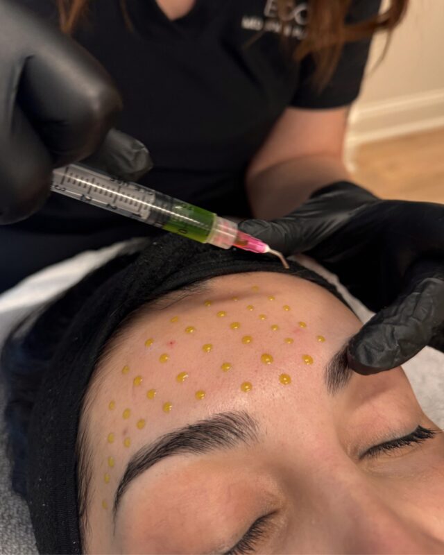 A reset.

BioRePeel works differently. It doesn’t strip, it restructures. A trichloroacetic acid base that signals your skin to repair from within, without the downtime of a traditional peel.

Link in bio to book