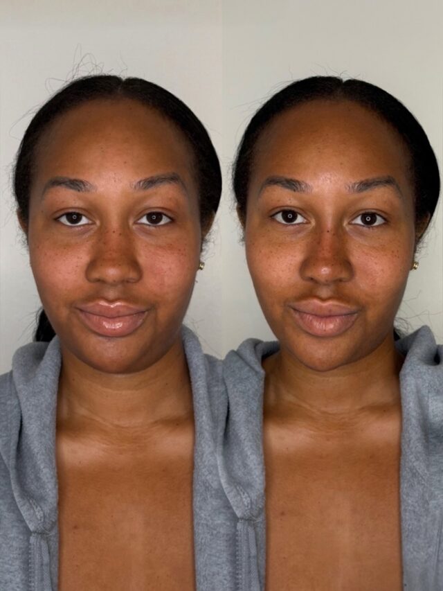 Subtle filler placement to create facial harmony.

Non-surgical rhinoplasty requires advanced training, precision placement, and a deep understanding of facial anatomy. This is what advanced filler placement looks like.

Non-Surgical Rhinoplasty | Ecobel Med Spa & Plastic Surgery
Atlanta, GA