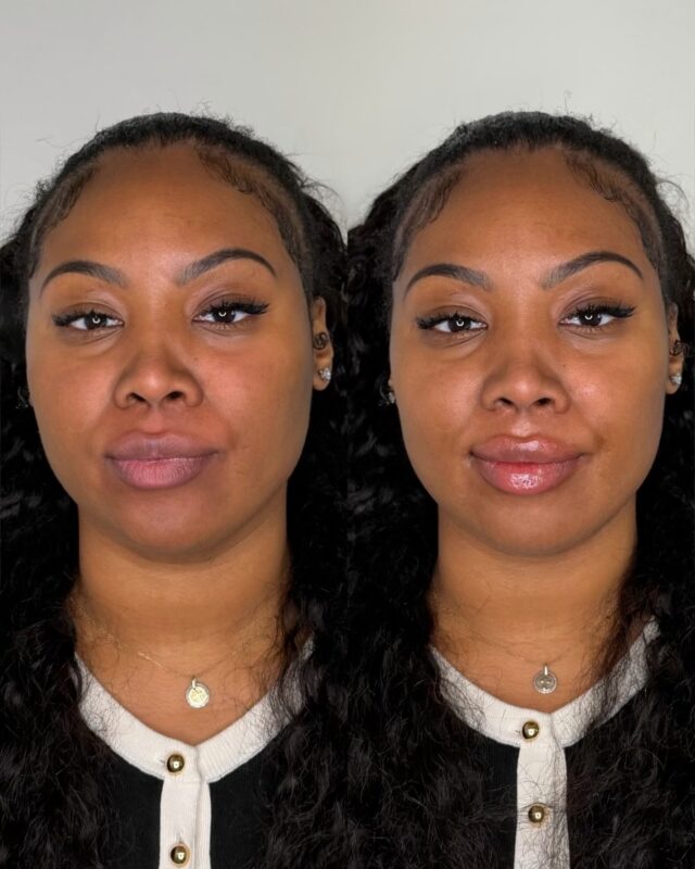 Soft, full and hydrated lips with effortless volume. Hyaluronic acid filler adds fullness and deep hydration to lips.