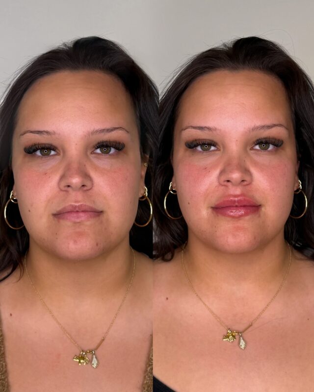 A subtle lip transformation. 

At Ecobel we use a technique that enhancing your lip shape while staying true to your own anatomy.

#atlantalipfillers #atlantainjectables #buckhead #atlantabeauty