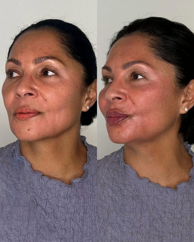 One of our favorite combinations.

Our treatments read the face as a whole, we treat in the right areas to create harmony. Placing cheek and lip filler can restore overall facial balance.