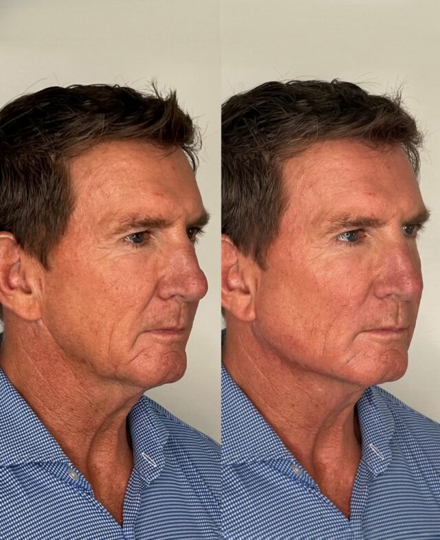 Results that build on themselves.

Radiesse does something most people don’t expect. Beyond filing small lines it stimulated your own collagen. This firms and refreshes from within, gradually over the weeks that follow post treatment. 

For men, that translates to a stronger jawline and a face that simply looks rested. Not done, just better.