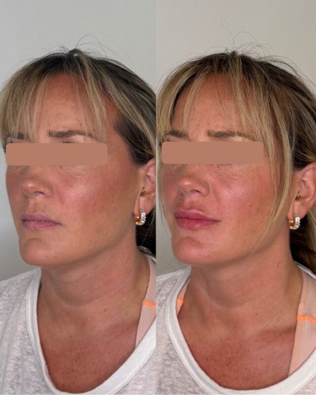 Balanced and Refined, but still you.

We place filler with intention instead of placing only for volume.
Lip filler with us is built around your existing structure. We focus on enhancing.

#naturalfillers #naturallipfiller #atlantamedicalspa