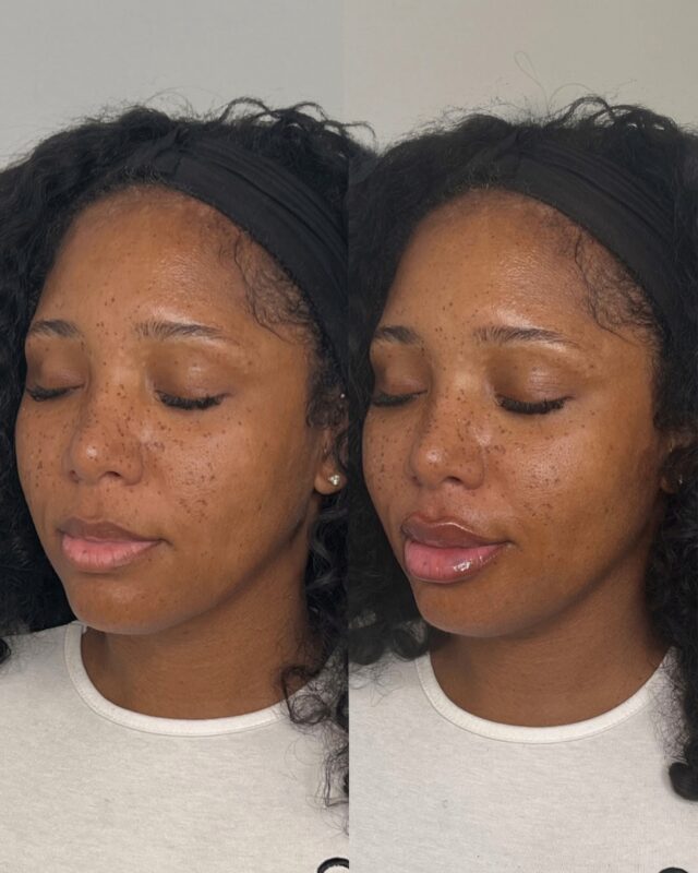 One of our favorites. Soft, balanced, and tailored to her desired lip shape.

Immediately post-treatment, lips look fuller than they’ll settle to. That is the swelling not filler. Over the next two weeks, that initial plump settles and the true result shows. A softer, more natural look exactly as intended.