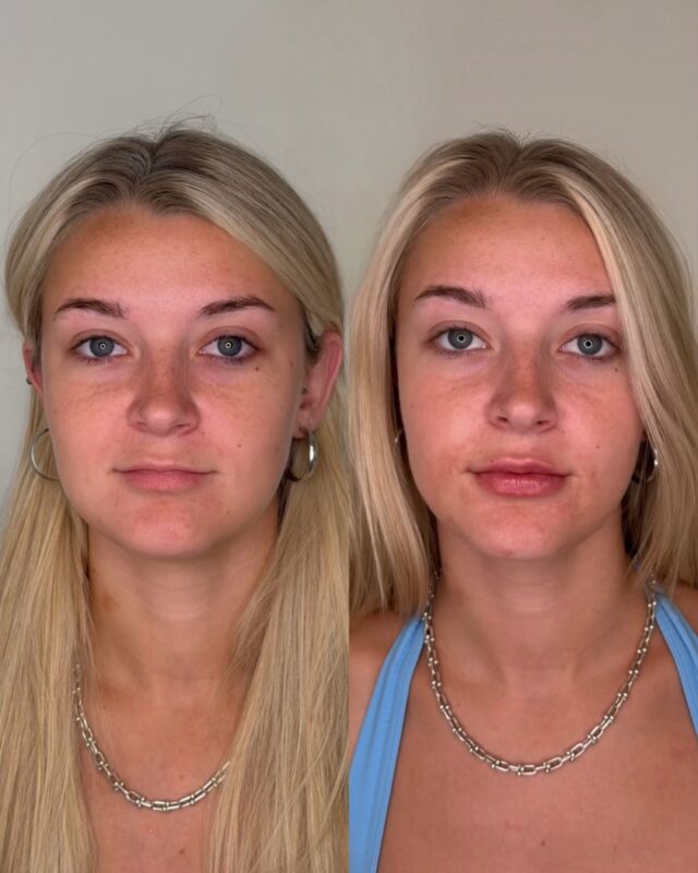 Subtlety, refined. Our lip filler approach favors natural definition over volume for its own sake a softened edge, a touch more balance, nothing that reads as done. 

Consultations open for those curious about their own version of enhancement.