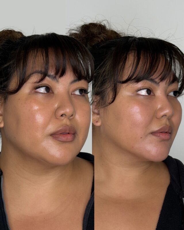 Chin filler with @restylane 

The chin isn’t an isolated feature, it anchors the whole lower face, projection, width, and the transition into the jawline all have to move together, or nothing looks right. A beautiful before and after to show how adding to one feature can enhance facial symmetry.